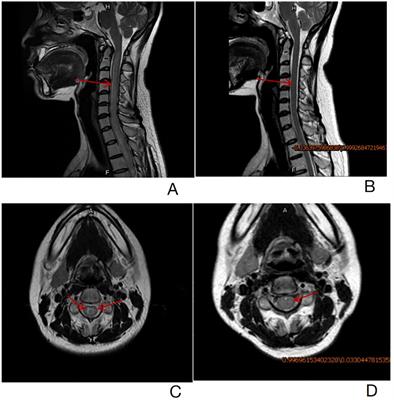 Metachronous spinal cord involvement B cell and subcutaneous tissue involvement NK/T cell lymphoid proliferations and lymphomas arising in post-transplantation mimicking general NK/T cell lymphoma: a case report and review of the literature